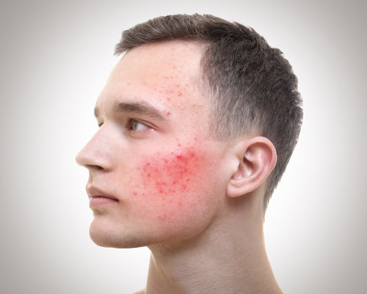 10 easy ways to lose acne redness